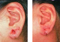 ピアス締めすぎによる耳垂裂を合併
