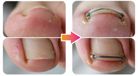 An Installation For A Toenail That The Free Edge Is Not Long Enough To Install Clips An Installation For A Toenail With Rounded Corners Naillift